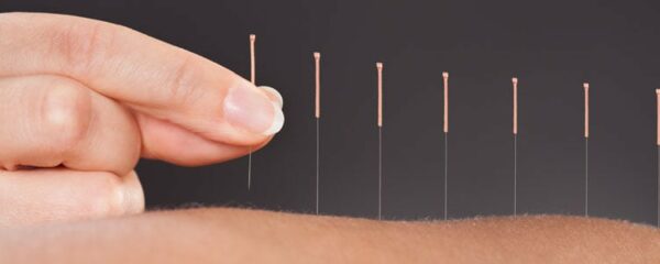 acupuncteur